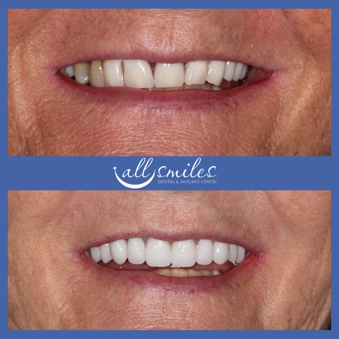 Before and after smile makeover, All Smiles Dental & Implant Centre, Bromley. Top: Discolored, uneven teeth. Bottom: Bright, straight, restored teeth.