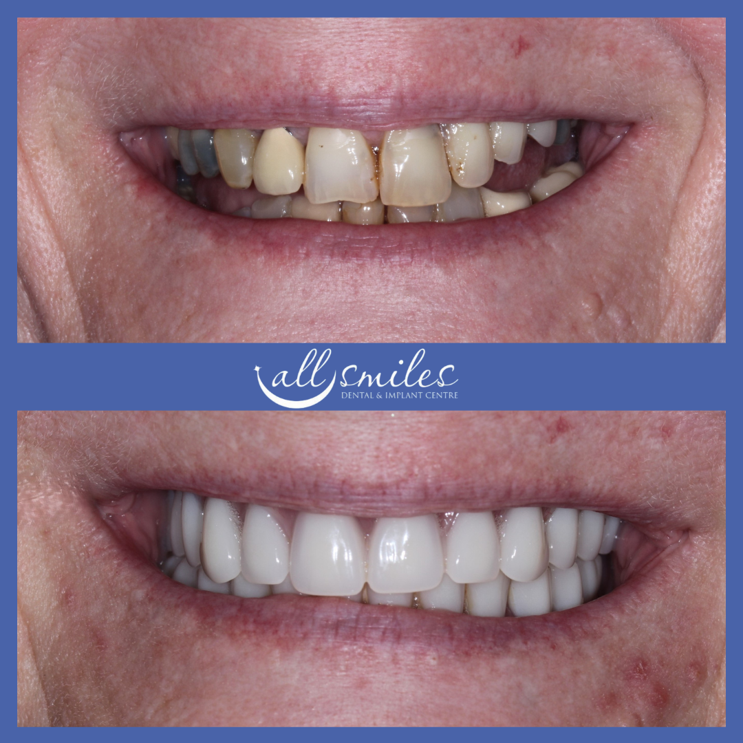 Before and after complete smile restoration, All Smiles Dental & Implant Centre, Bromley. Top: Damaged, discolored, and missing teeth. Bottom: Bright, straight, and fully restored smile