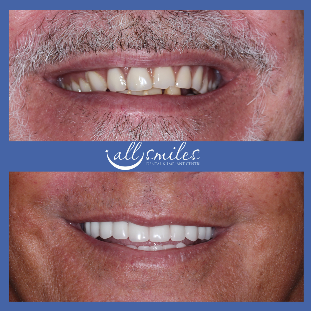 Before and after cosmetic dental makeover, All Smiles Dental & Implant Centre, Bromley, England. Top: Discolored, misaligned teeth. Bottom: Bright, straight, restored smile.