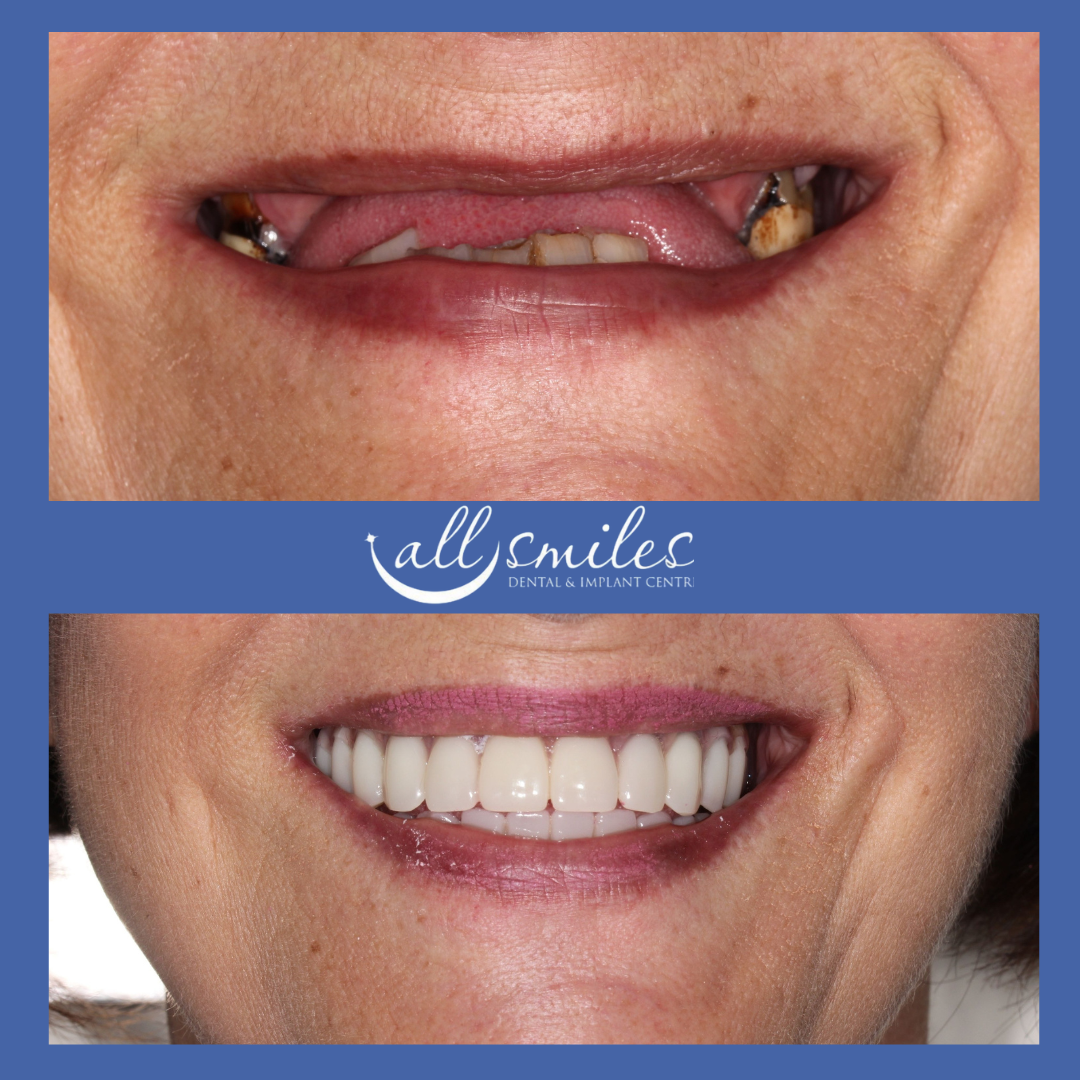 Before and after full mouth dental implants, All Smiles Dental & Implant Centre, Bromley, England, UK. Top: Missing teeth, exposed gums. Bottom: Full set of bright, restored teeth.