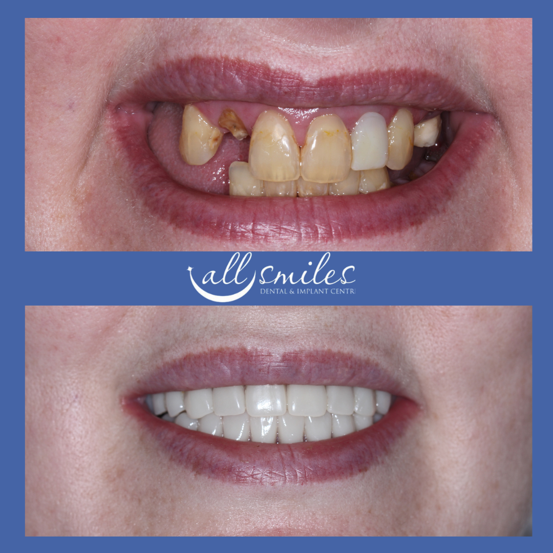 "Before and after smile transformation, All Smiles Dental & Implant Centre, Bromley, England, UK. Top: Damaged, discolored, and uneven teeth. Bottom: Bright, straight, and restored smile.