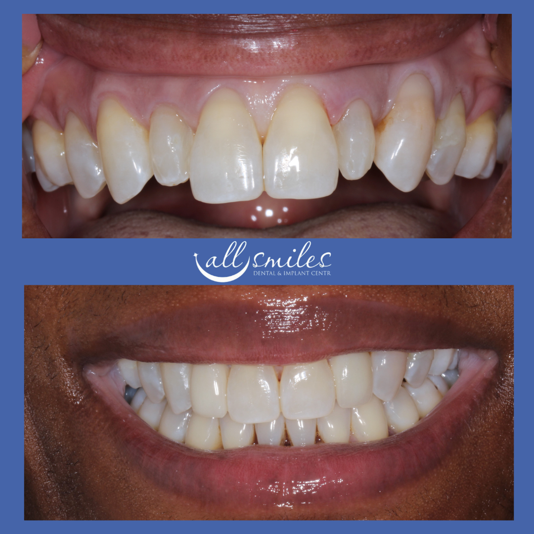 Before and after dental veneers for peg laterals, All Smiles Dental & Implant Centre, Bromley, England, UK. Top: Small, pointed peg lateral incisors. Bottom: Straight, even, natural-looking veneers.