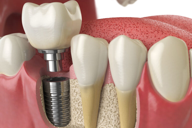 Titanium dental implant with crown in gums